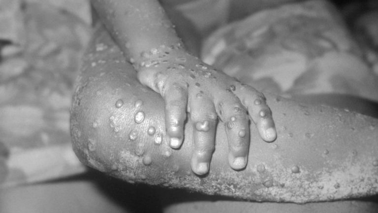 Belgium introduces mandatory monkeypox quarantine as global cases rise