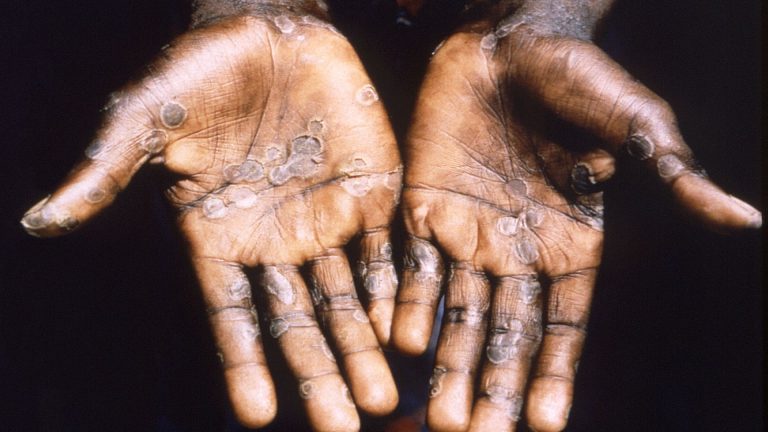 Dr. Scott Gottlieb says rising monkeypox cases suggest it’s spread ‘pretty wide’