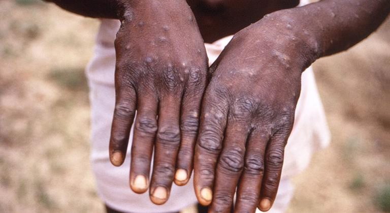 Minimal risk of monkeypox transmission in UK following confirmed case |