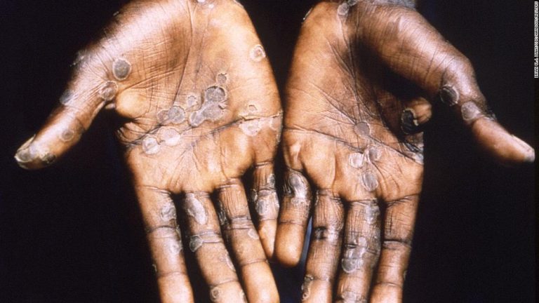 What is monkeypox and its signs and symptoms?