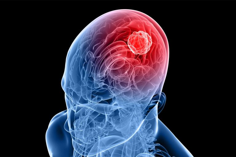 After 7 Years of Research, Scientists Have Discovered a New Treatment for Devastating Brain Tumors