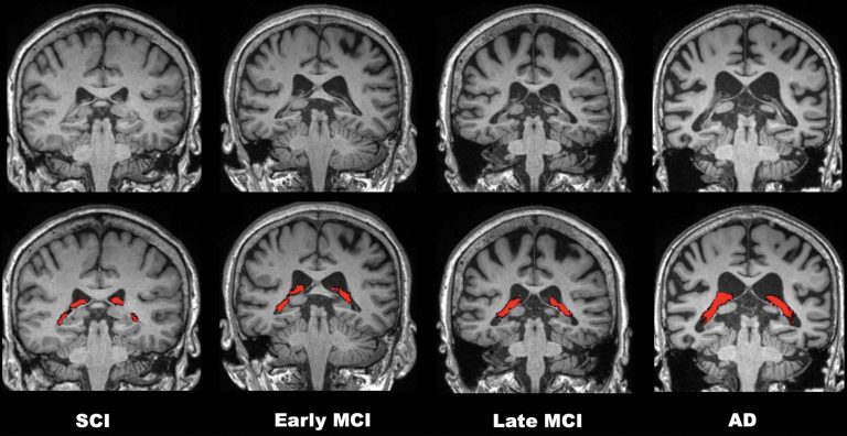 Volume of Choroid Plexus in Brain Linked to Alzheimer’s Disease