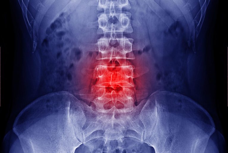 Gene Therapy Successfully Treats Spinal Cord Injuries Without Side Effects