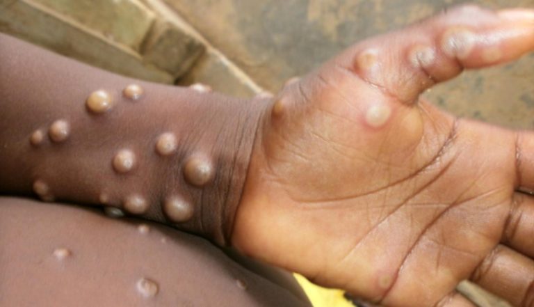 What Is Monkeypox? A Microbiologist Explains What’s Known About This Disease