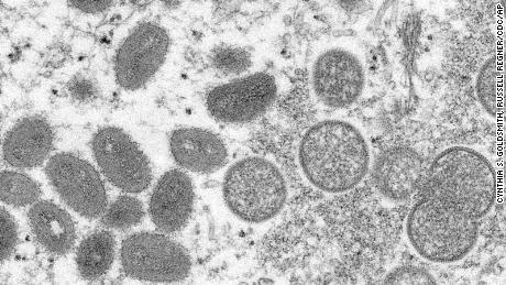 CDC monitors 6 people in US for possible monkeypox, but says public &#39;should not be concerned&#39;