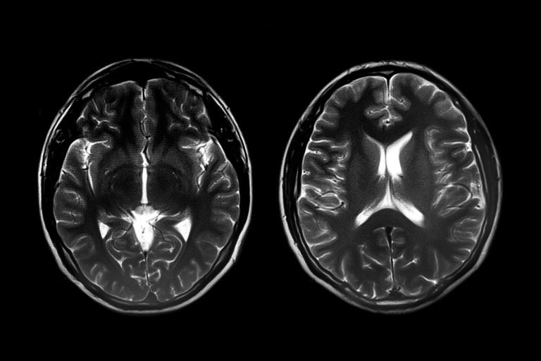 Changes in Brain’s Visual Processing Areas in Infancy Before Autism Diagnosis