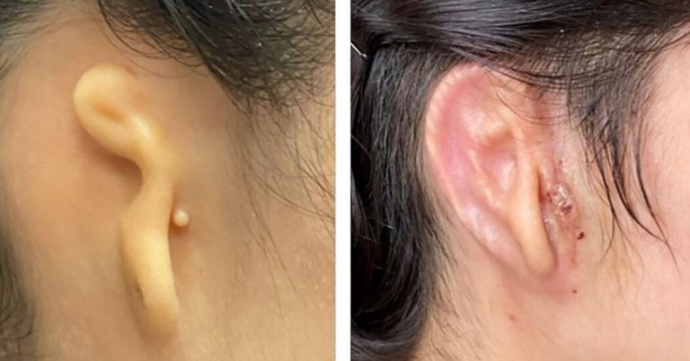 Doctors Transplant 3-D Printed Ear Made of Human Cells