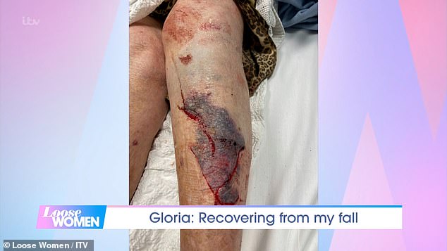 Gruesome! The TV presenter suffered the accident when she tripped over a rug onto a 'very hard wooden floor' earlier this month, and unveiled the extent of her gruesome leg injuries