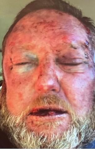 The 57-year-old presented to hospital with serious facial injuries. A photo of the aftermath show Addison bloodied and bruised, with his eyes so swollen he can hardly open them