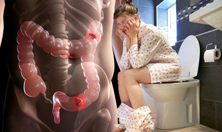 Bowel cancer: The ‘feeling’ after ‘opening your bowels’ that can signal the deadly disease