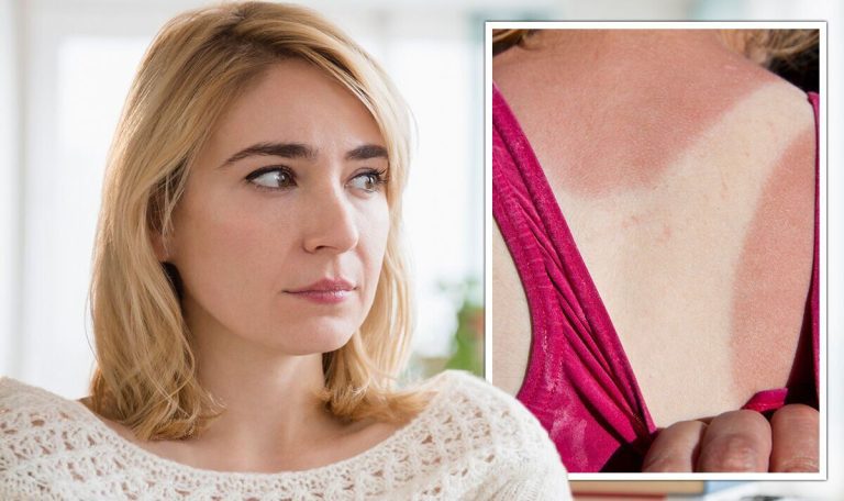 Cancer symptoms: Melanoma risk is TRIPLED each time you have a sunburn – signs