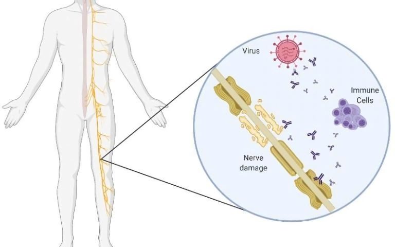 Increase in Guillain-Barré Syndrome Following AstraZeneca COVID-19 Vaccine