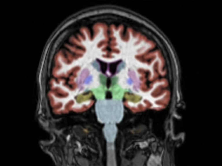 Long Missions Trigger Significant Changes in Astronauts’ Brains