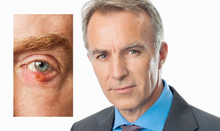 Waking up with a lump on your eyelid could be a ‘chalazion’ – signs and treatment