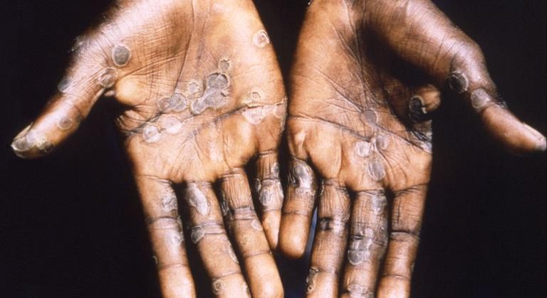 Monkeypox transmission may have gone undetected ‘for some time’ |