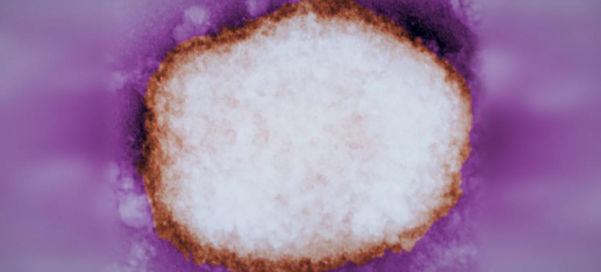 A highly-magnified image shows a mulberry-type Monkeypox virus particle, which was found in the fluid of a human blister.