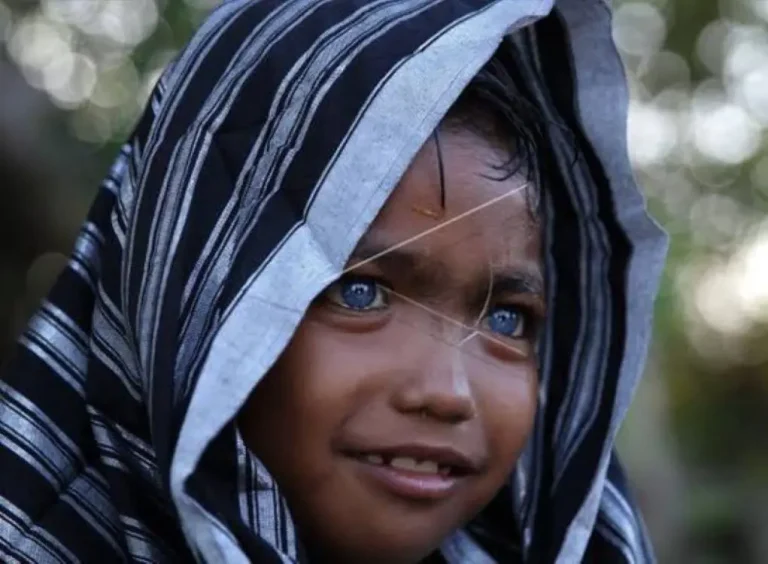  Buton Tribe Eyes Are Blue Due To Waardenburg Syndrome: Disease Meaning, Types, Cause & Treatment