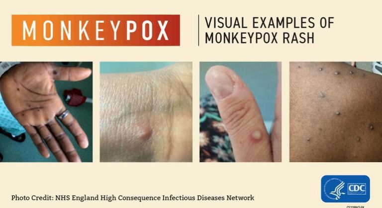 Emergency Committee meets again as Monkeypox cases pass 14,000: WHO |