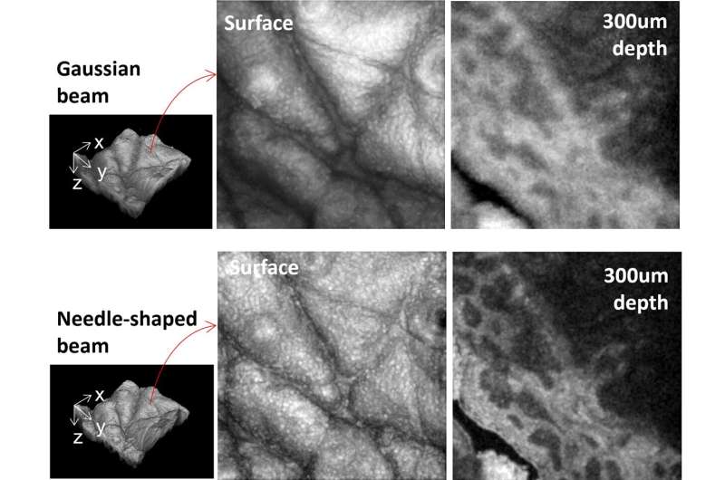 Flexible method for shaping laser beams extends depth-of-focus for OCT imaging