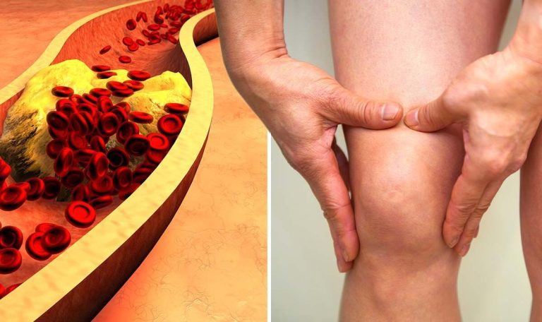 High cholesterol symptoms: The sign when you walk that ‘requires quick reaction’ – expert