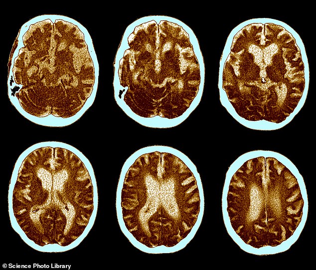 Manipulated results in Alzheimer’s study with gave false hope to families, scientists say