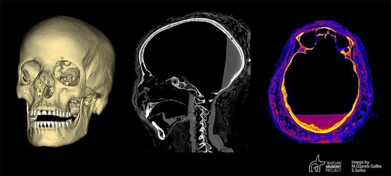 Mummy of the Mysterious Lady may have had nose or throat cancer