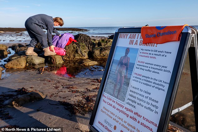 She started a 'bikini challenge' where she wore nothing but a bikini and took a sign to the local beach saying she had a stoma from childbirth