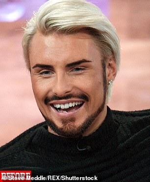 Before: Before he had his veneers in 2011