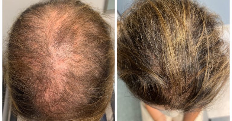 An Old Medicine Grows New Hair for Pennies a Day, Doctors Say