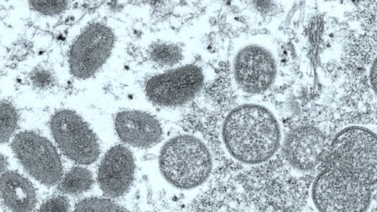 Monkeypox: First US death due to the virus confirmed in Los Angeles County