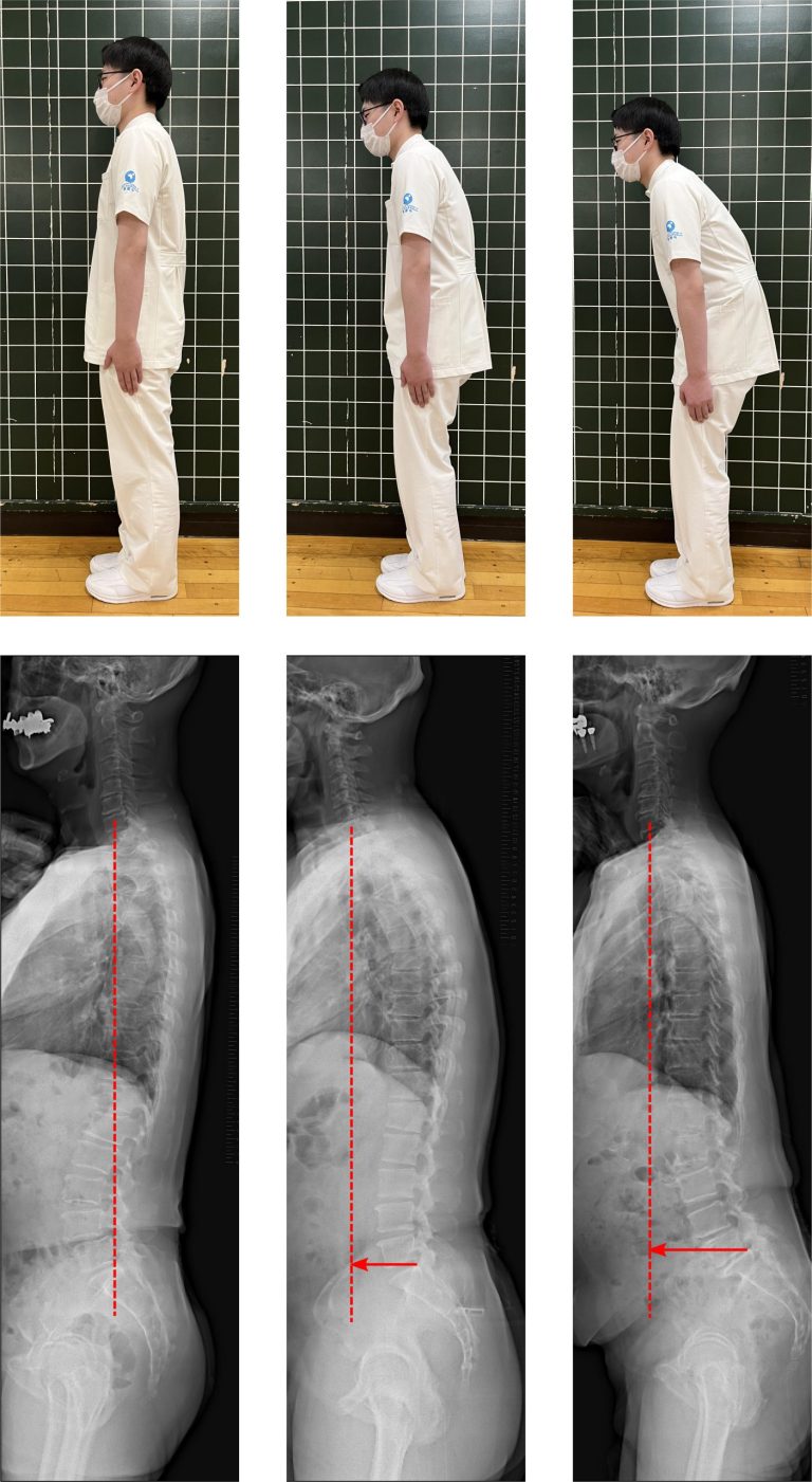 Shocking Relationship Discovered Between Posture and Cognitive Decline