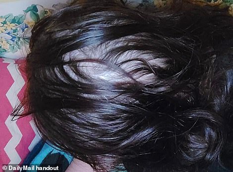 Women who suffered hair loss after a bout with COVID-19 describe how it hurt their self-esteem