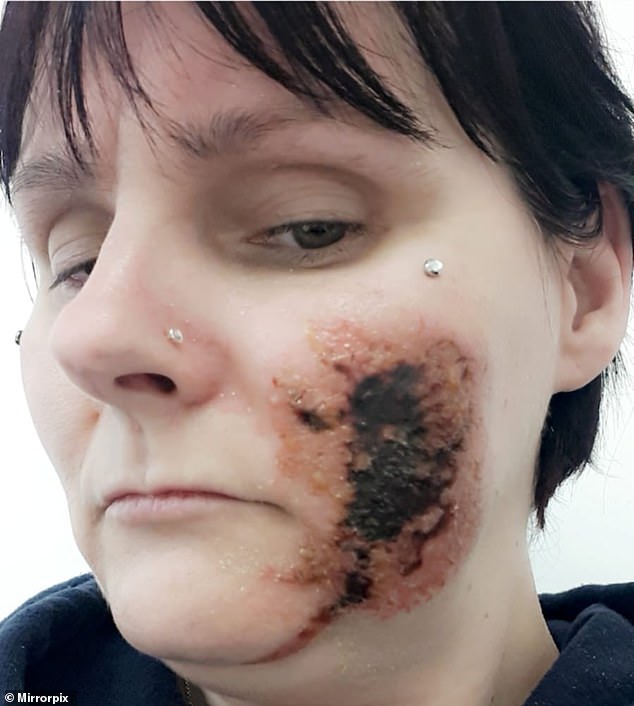 Mother-of-six, 45, left with a hole in her cheek after oven cleaner got on her face