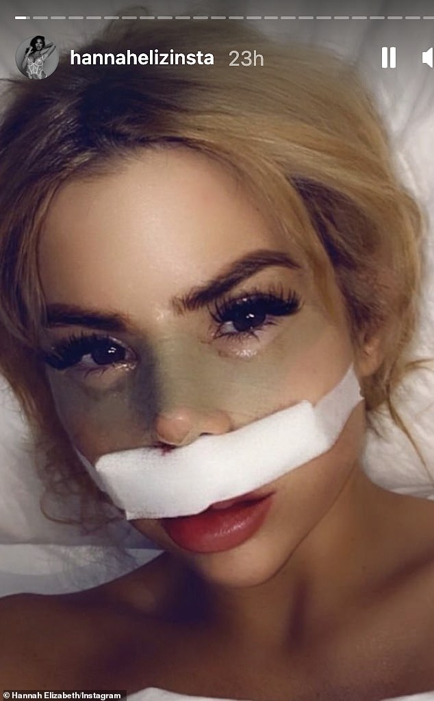 In recovery: No stranger to surgery Hannah Elizabeth showed of the painful-looking after effects of her rhinoplasty on Instagram earlier this year