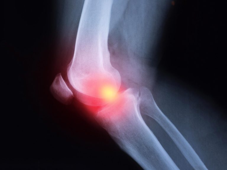 Pain Relievers Like Ibuprofen and Naproxen May Worsen Arthritis Inflammation