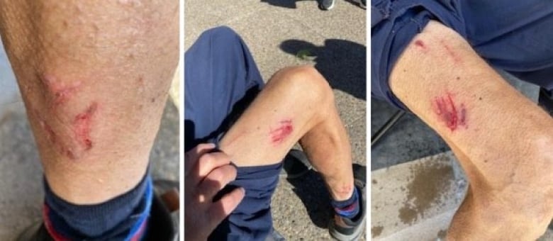 Three photos of dog bites on a leg