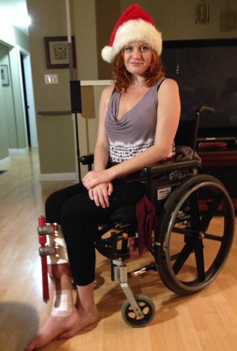 A woman wearing a Santa hat sits in a wheelchair with a large metal bar attached to her leg.