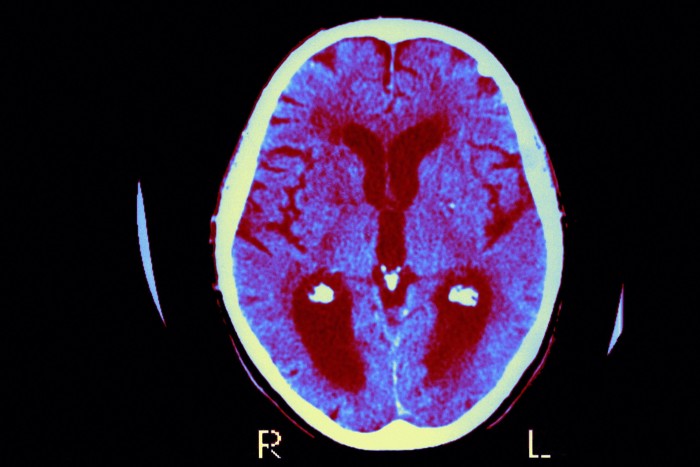 An Alzheimer’s disease brain scan