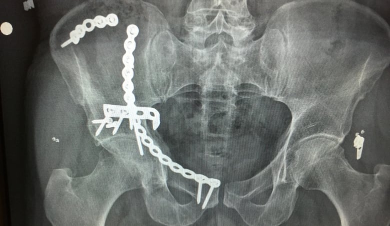 An exray shows pins holding together bones in a man's pelvis 