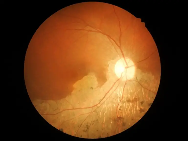 Age Related Macular Degeneration