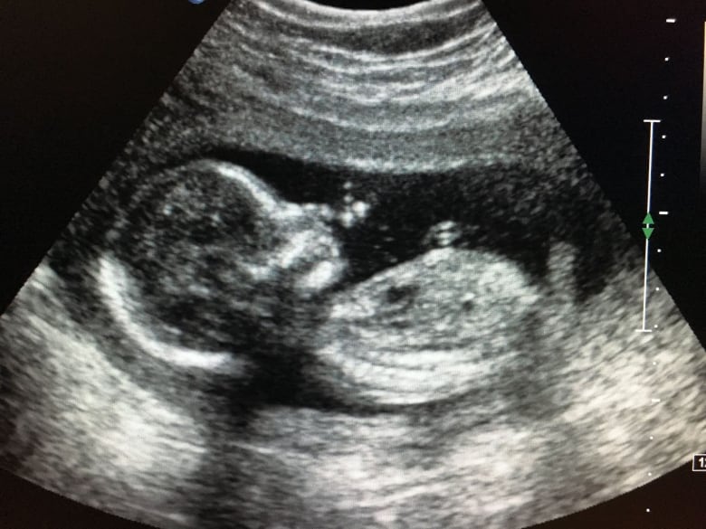 An ultrasound image of a fetus.