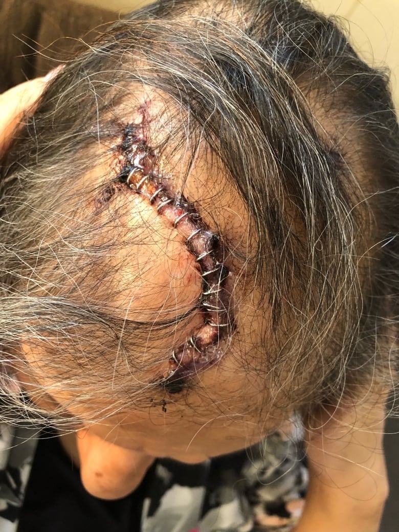 The top of a woman's head showing 17 staples closing a wound.