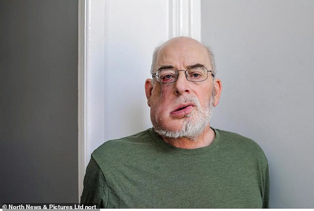 Man, 64, who couldn’t get NHS dental appointment diagnosed with cancer after going private