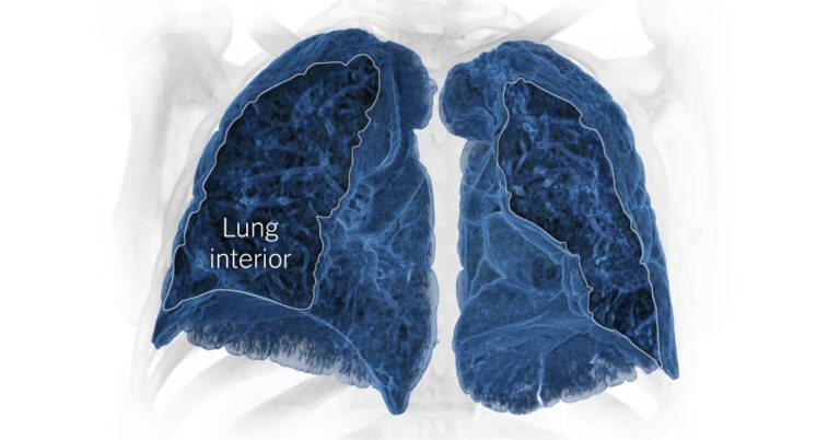 An Inside Look at Covid’s Lasting Damage to the Lungs