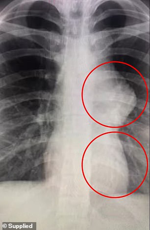 The tumours growing in Marnie's chest and abdomen are visible in this X-ray