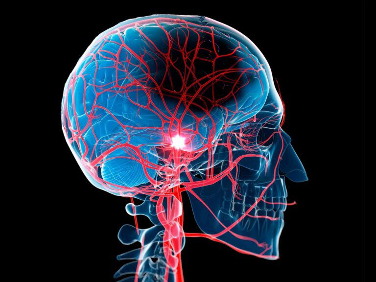 Language and Stroke – Scientists Uncover Surprising Connection