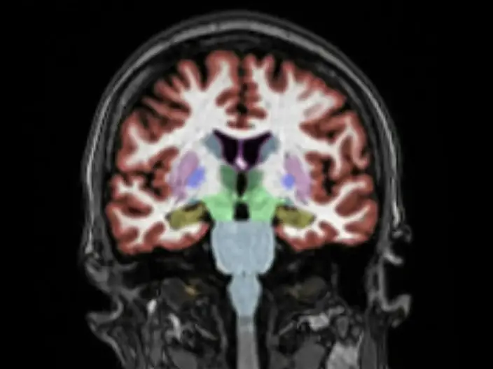 MRI Brain Image