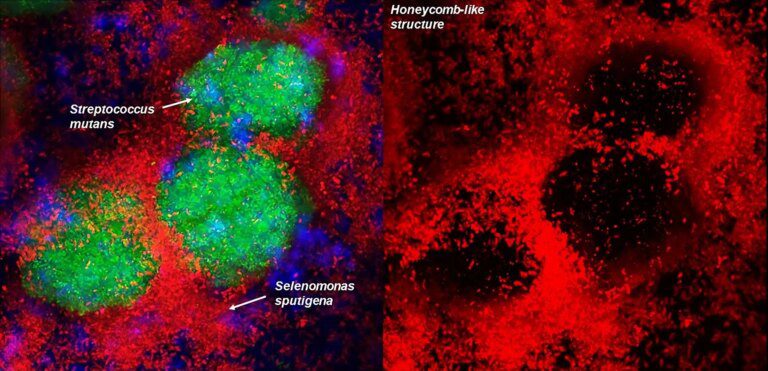 Tooth Decay Surprise: New Bacterial Culprit Discovered