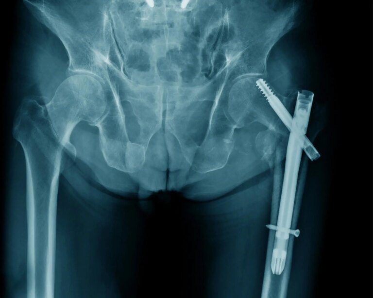 Study Shows 50% Increased Risk of Hip Fracture in Vegetarians