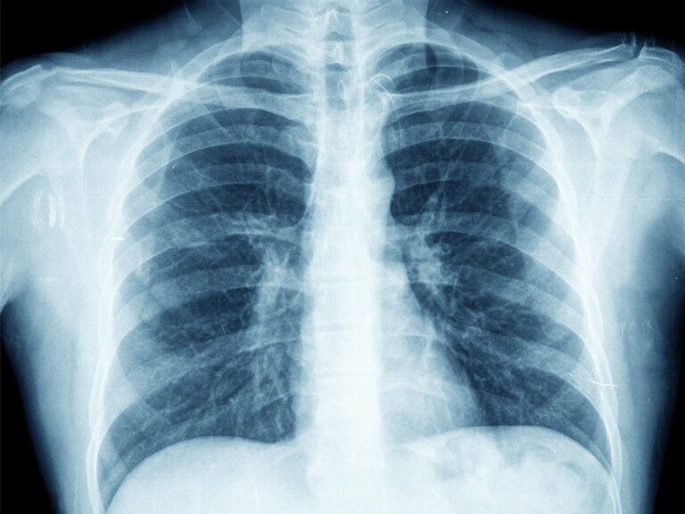 Outperforming AI in Identifying Lung Diseases on Chest X-Rays